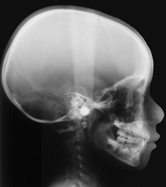 Consultation orthodontie, sécurité sociale, mutuelles